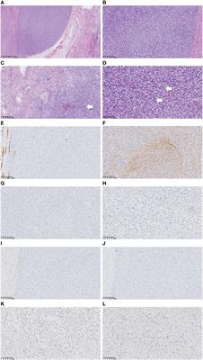 Case Report: A case of COL1A1–PDGFB fusion uterine sarcoma at cervix and insights into the clinical management of rare uterine sarcoma